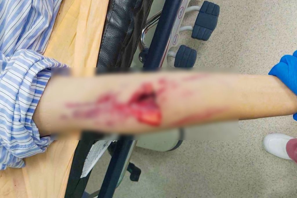 影音/少年騎車自摔脾臟碎裂  彰基整合創傷團隊成功搶救