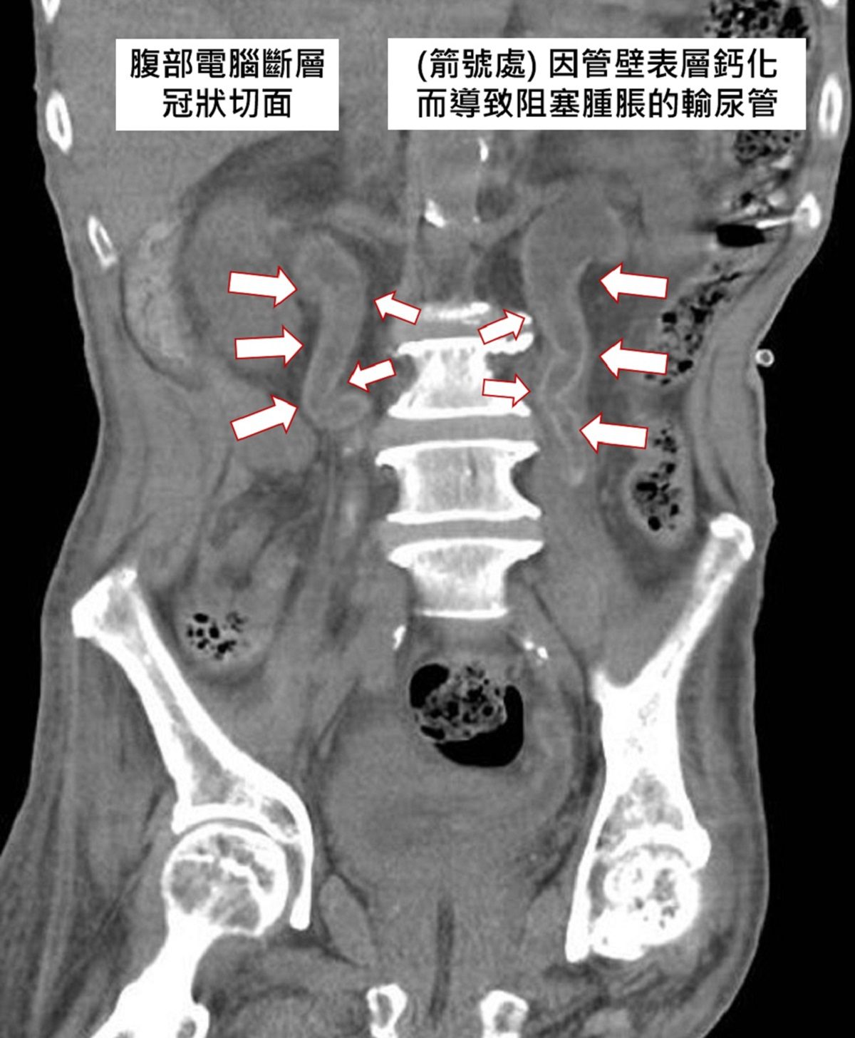 影音/結石不成塊滿覆蓋泌尿道　醫師：多喝水 不要憋尿 適度運動