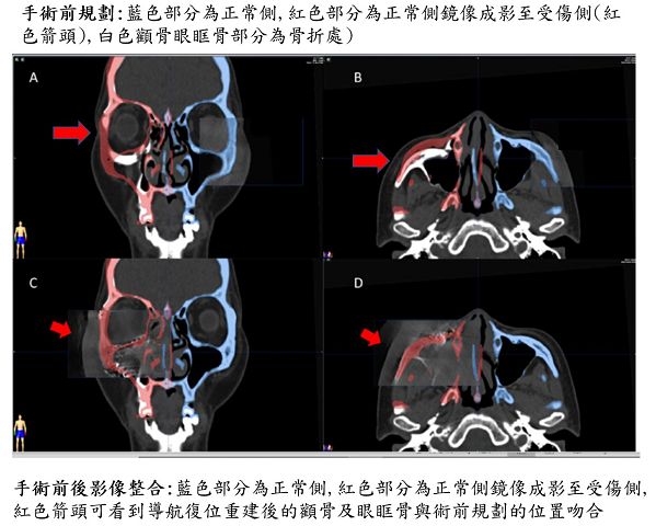 精準顱顏面重建的新利器　術中即時導航輔助及電腦斷層手術