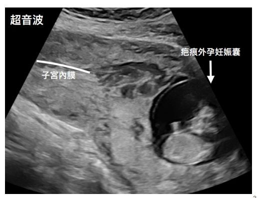 臺大醫院助「剖腹產疤痕外孕」產婦順產 成果登頂尖國際期刊