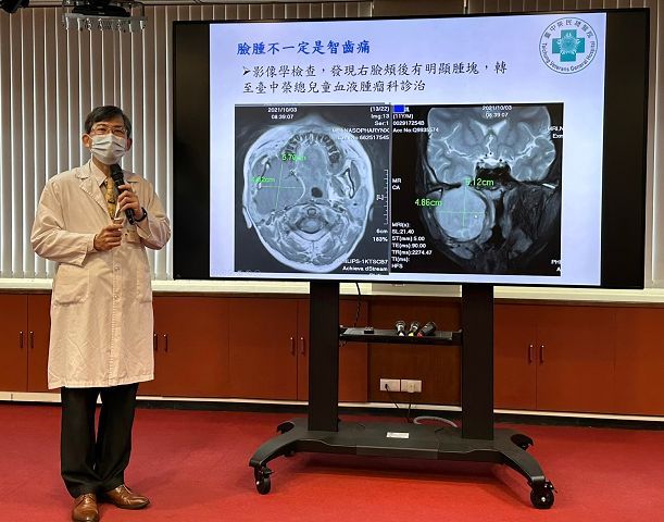 臉腫不一定是智齒痛　小心橫紋肌肉瘤作怪