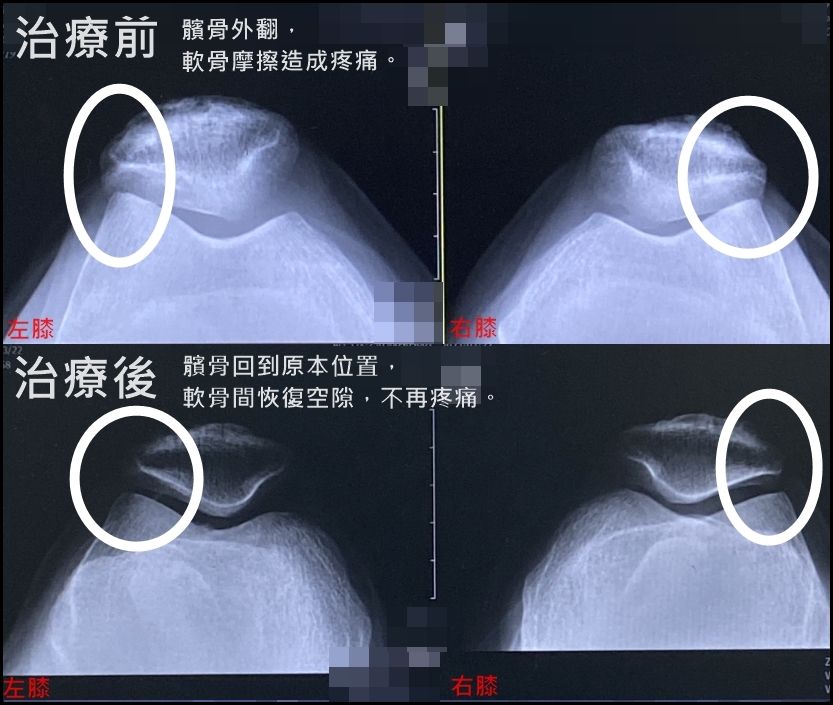 跑步跑到髕骨外翻　肉毒桿菌治療解決膝蓋疼痛問題