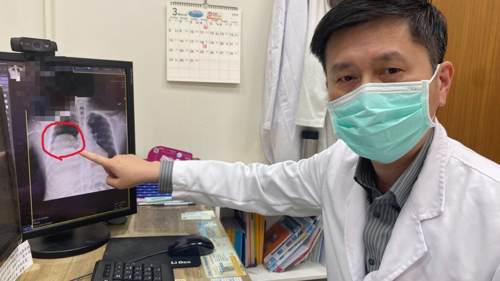 男子低血糖反覆發作竟非糖尿病  多次昏迷送醫揪出25公分罕見肺腫瘤