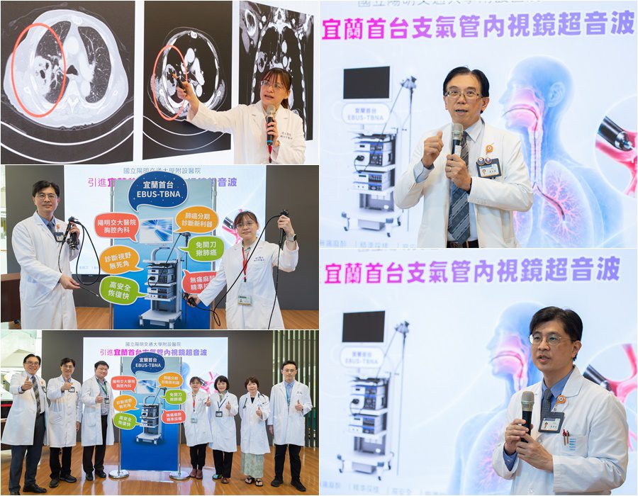增添診斷肺癌新利器　陽明交大醫院引進支氣管內視鏡超音波