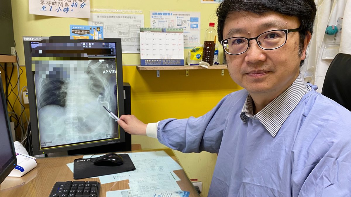 高燒39度血氧狂跌  55歲男肺炎惡化成膿胸  微創引流搶回一命