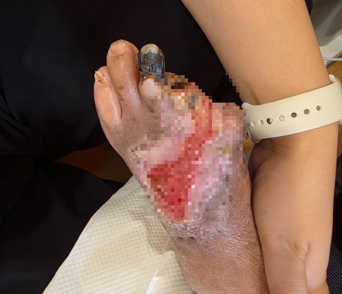 婦剪趾甲竟變截掉兩根腳趾  經歷清創靠中醫雷射針灸重新站起來