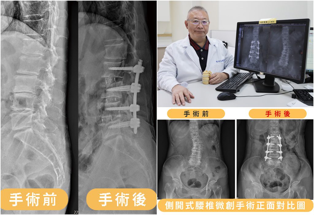 側開式腰椎微創手術　治癒八旬嬤背痛與駝背